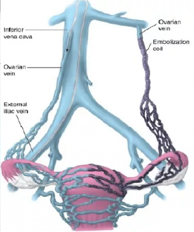 varicose veins of the pelvis varicose veins of the pelvis